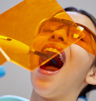 Composite veneers & tooth fillings 1, dental services at The Smile Collective Dental Clinics