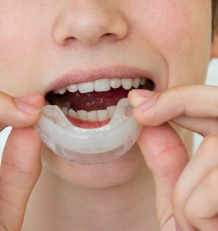 Custom Fitted Mouthguards 1, The Smile Collective