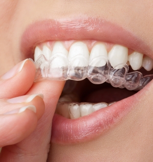 Pola At Home Whitening, teeth whitening, The Smile Collective