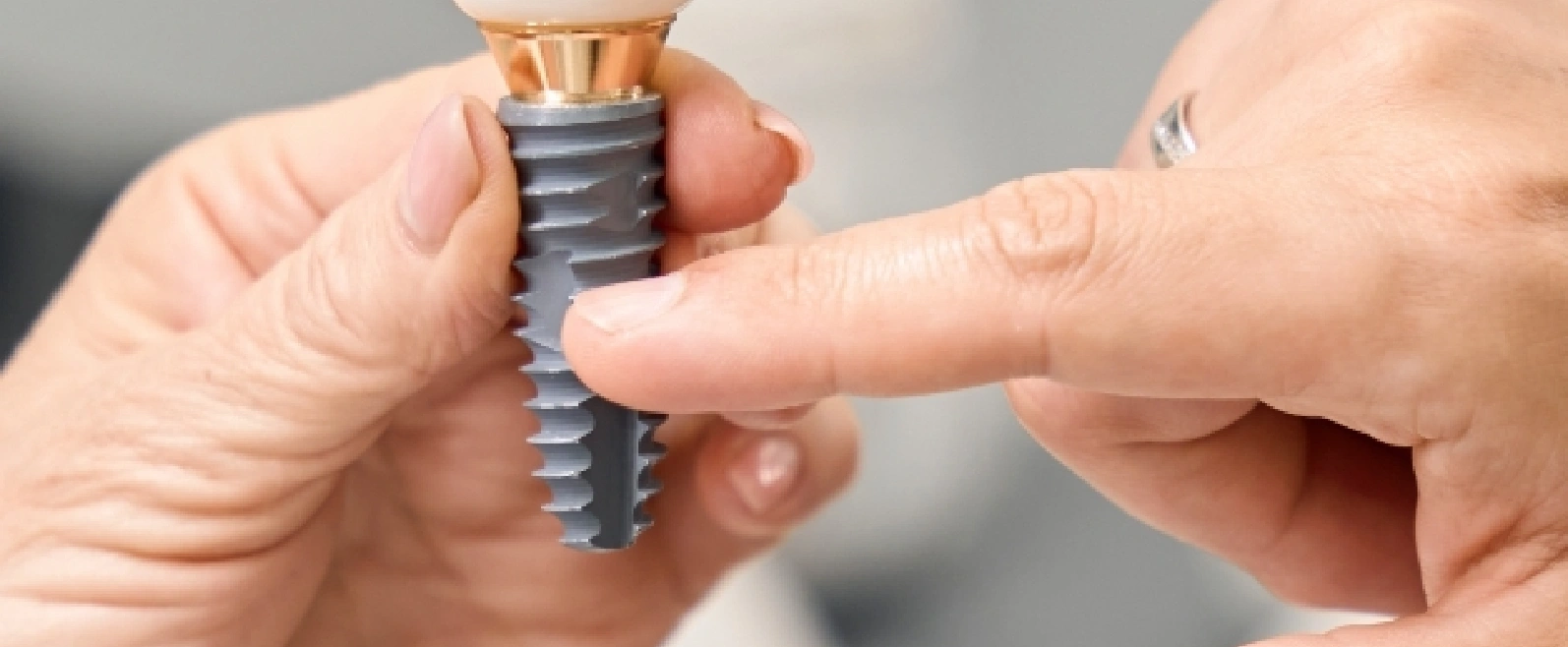Dental implants, blog 1