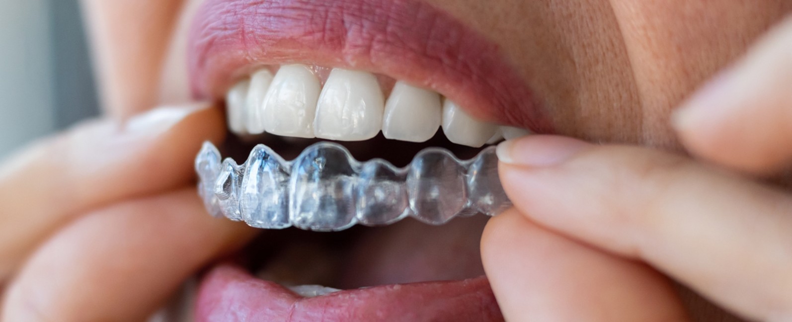 Patient fitting a clear Invisalign aligner tray over their upper teeth, invisalign cost melbourne blog
