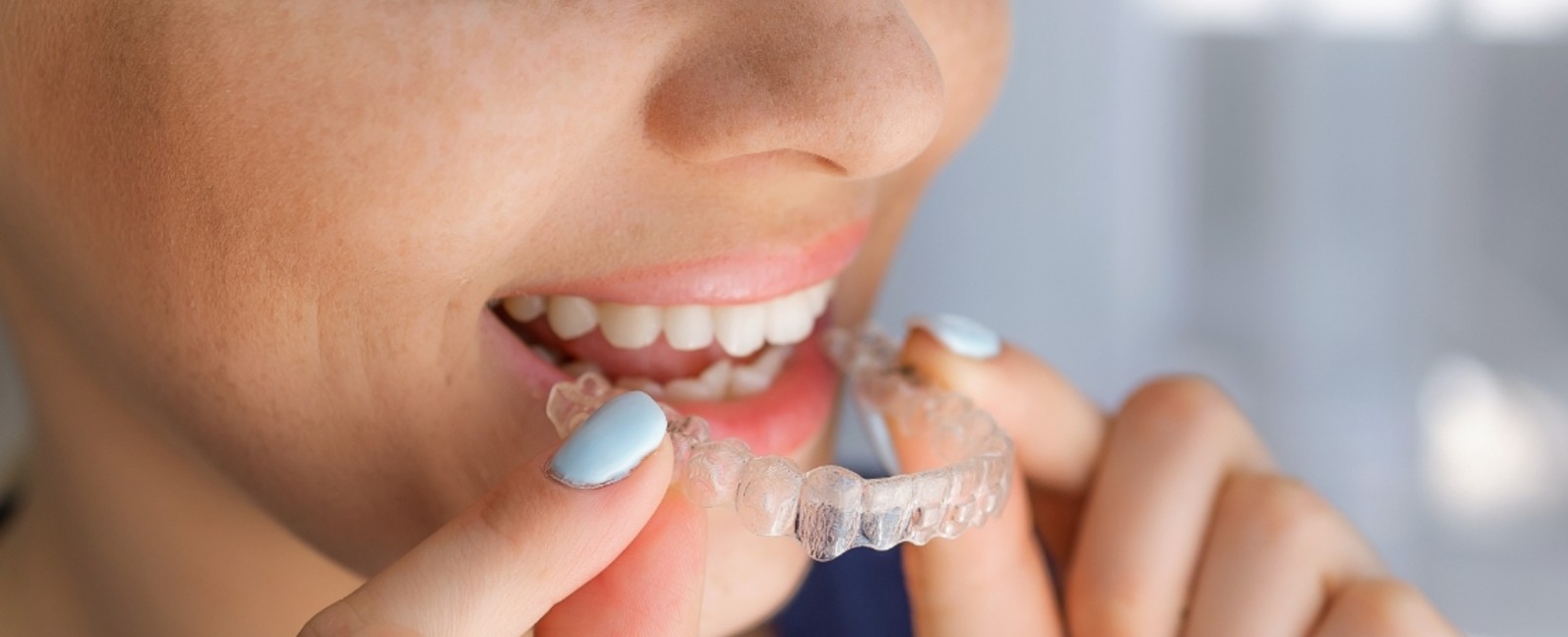 Woman placing a clear aligner over her teeth, invisalign vs braces blog 1