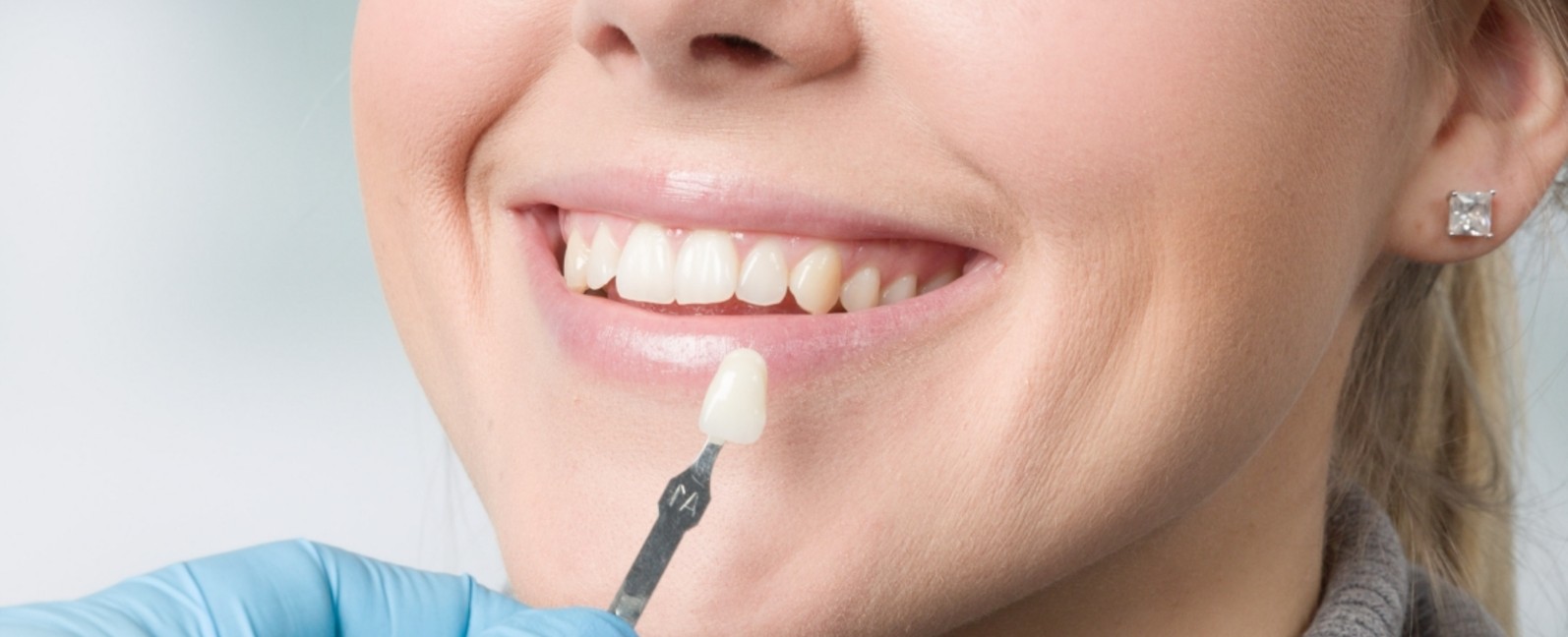 Dentist matching a porcelain veneer shade guide against a patient’s smile